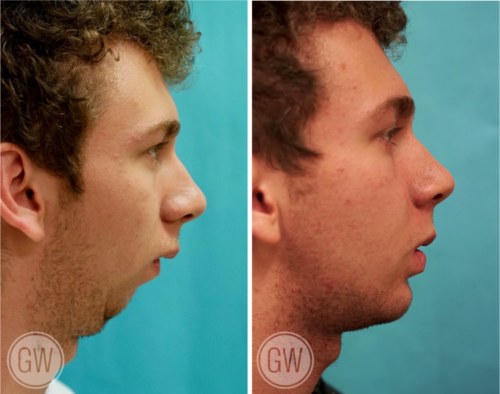 before and after - ყბის პლასტიკური ოპერაცია