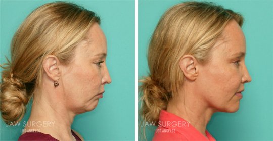 before and after - ყბის პლასტიკური ოპერაცია
