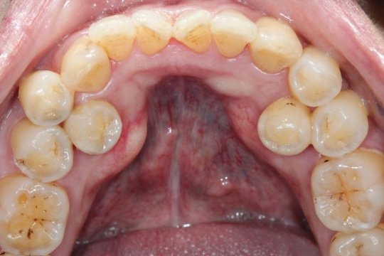 ზეკომპლექსური  კბილები
