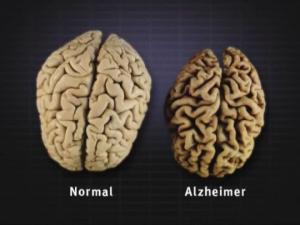 რა არის ალცჰაიმერის დაავადება და არსებობს თუ არა მისი მკურნალობის გზები?