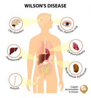 ვილსონის დაავადება, მისი გამომწვევი მიზეზები, რისკ ფაქტორები, დიაგნოსტირება და მკურნალობის გზები.