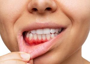 „ღრძილების ანთებას თუ არ ვუმკურნალებთ, კბილი შეიძლება დაკარგოთ“ - ექიმი პაროდონტოლოგი მარი ჩიხრაძე