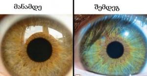 რა შემთხვევაში შეიძლება შეიცვალოს ჩვენი თვალის ფერი