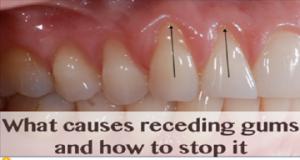 წაისვით ეს ორი ზეთი კბილებზე და ღრძილებზე, თქვენ აღარ დაგჭირდებათ სტომატოლოგთან ვიზიტი