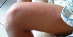 გაინტერესებთ, რატომ გკბენენ კოღოები თქვენ უფრო მეტად,ვიდრე სხვებს?  მაშინ წაიკითხეთ ეს სტატია...