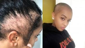 გოგონა რომელიც თმის ვარცხნილობის შემდეგ გამელოტდა და მოუწია თმის გადანერგვა