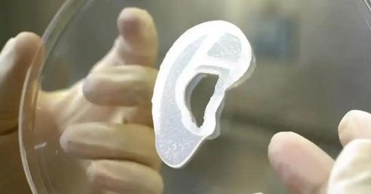 ექიმებმა პაციენტს 3D პრინტერზე დაბეჭდილი ყური გადაუნერგეს