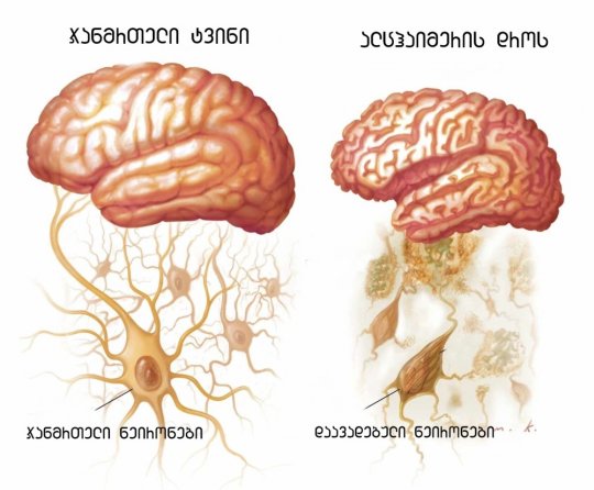 ალცჰაიმერის დაავადებას შესაძლოა ჰერპესის და ჩუტყვავილას ვირუსების შეამხანაგება იწვევდეს