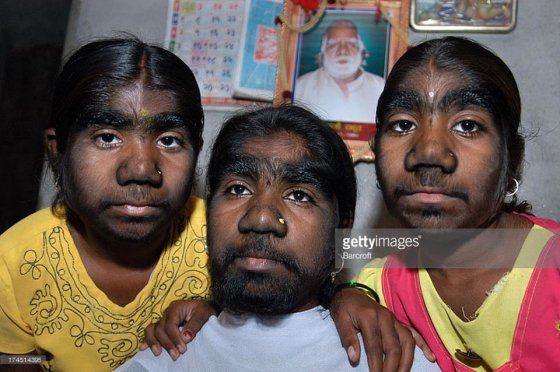 ჰიპერტრიქოზით (ჭარბთმიანობა) დაავადებული ინდოელი  დები