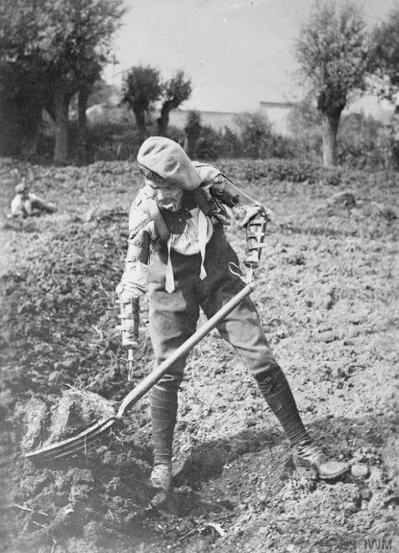 ბრიტანელი ჯარისკაცი, რომელმაც პირველ მსოფლიო ომში ორივე ხელი დაკარგა