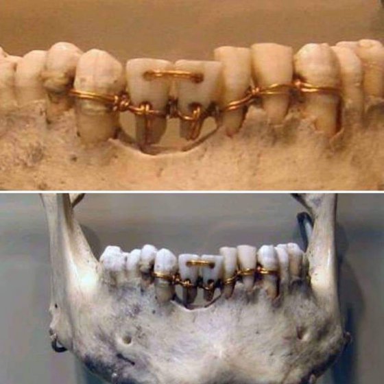 ეს სენსაციაა-ეგვიპტეში აღმოჩენილ მუმიას ქვედა ყბაზე კბილები ასე ჰქონდა გამაგრებული