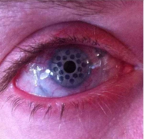როგორ გამოიყურება ადამიანის თვალში '' ხვრელები''